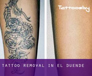 Tattoo Removal in El Duende