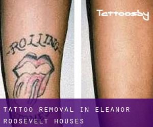 Tattoo Removal in Eleanor Roosevelt Houses