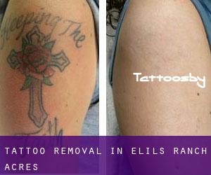 Tattoo Removal in Elils Ranch Acres