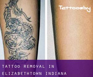 Tattoo Removal in Elizabethtown (Indiana)