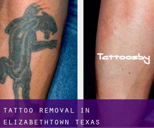 Tattoo Removal in Elizabethtown (Texas)