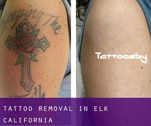 Tattoo Removal in Elk (California)