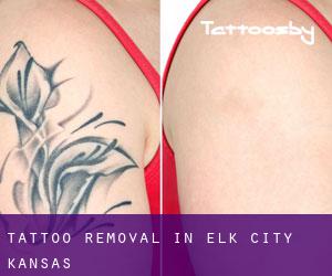 Tattoo Removal in Elk City (Kansas)