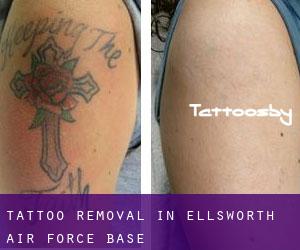 Tattoo Removal in Ellsworth Air Force Base