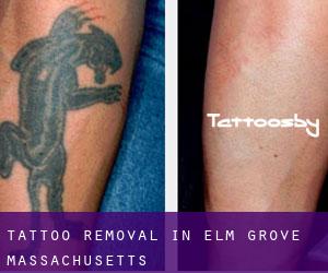 Tattoo Removal in Elm Grove (Massachusetts)