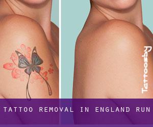 Tattoo Removal in England Run