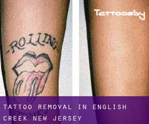 Tattoo Removal in English Creek (New Jersey)