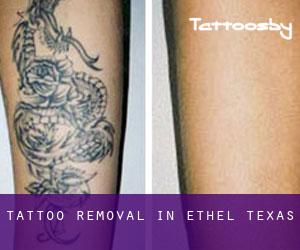 Tattoo Removal in Ethel (Texas)