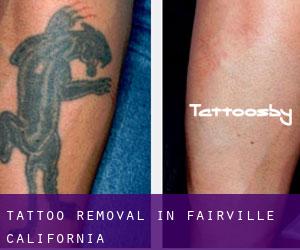 Tattoo Removal in Fairville (California)