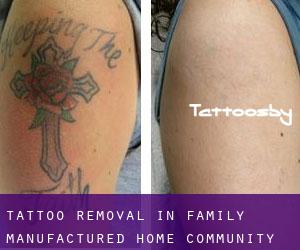 Tattoo Removal in Family Manufactured Home Community