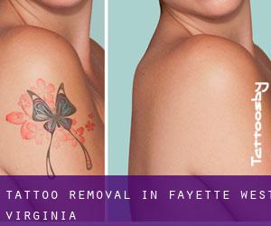 Tattoo Removal in Fayette (West Virginia)