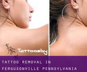 Tattoo Removal in Fergusonville (Pennsylvania)