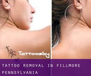 Tattoo Removal in Fillmore (Pennsylvania)