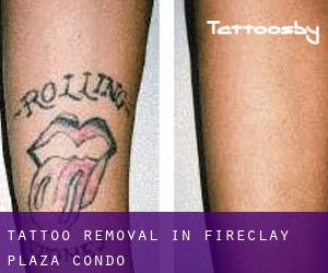 Tattoo Removal in Fireclay Plaza Condo