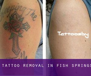 Tattoo Removal in Fish Springs