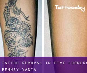 Tattoo Removal in Five Corners (Pennsylvania)