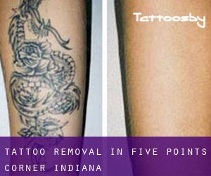 Tattoo Removal in Five Points Corner (Indiana)