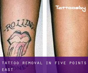 Tattoo Removal in Five Points East