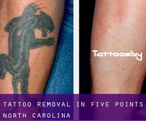 Tattoo Removal in Five Points (North Carolina)