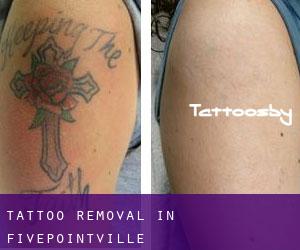 Tattoo Removal in Fivepointville
