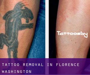 Tattoo Removal in Florence (Washington)