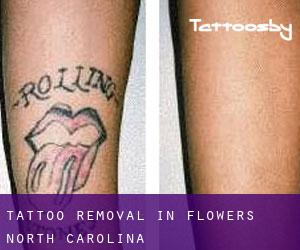 Tattoo Removal in Flowers (North Carolina)