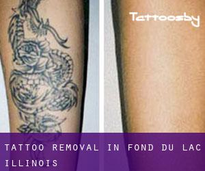 Tattoo Removal in Fond du Lac (Illinois)