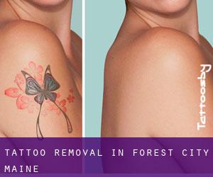 Tattoo Removal in Forest City (Maine)