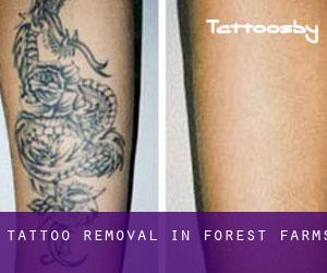 Tattoo Removal in Forest Farms