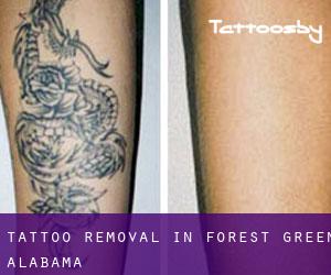 Tattoo Removal in Forest Green (Alabama)
