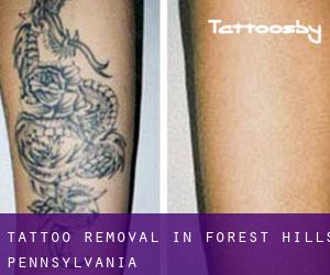 Tattoo Removal in Forest Hills (Pennsylvania)