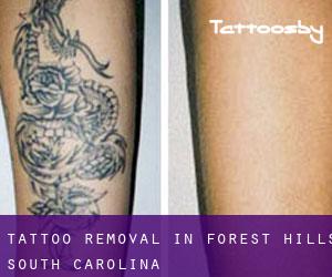 Tattoo Removal in Forest Hills (South Carolina)