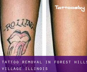 Tattoo Removal in Forest Hills Village (Illinois)