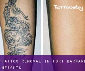 Tattoo Removal in Fort Barnard Heights