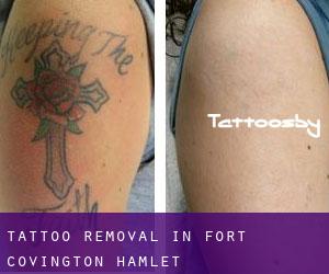 Tattoo Removal in Fort Covington Hamlet