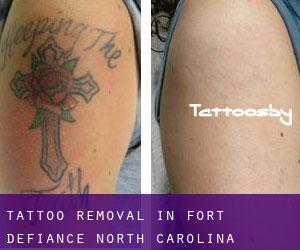 Tattoo Removal in Fort Defiance (North Carolina)