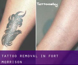 Tattoo Removal in Fort Morrison