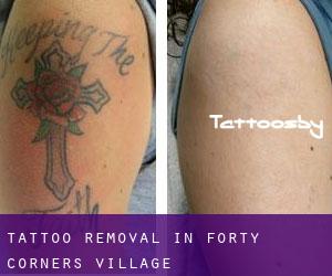 Tattoo Removal in Forty Corners Village
