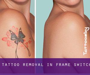Tattoo Removal in Frame Switch