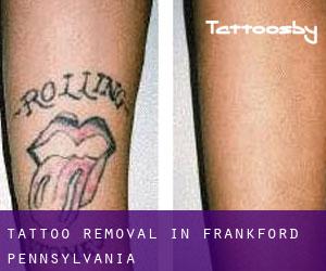 Tattoo Removal in Frankford (Pennsylvania)