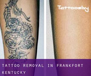 Tattoo Removal in Frankfort (Kentucky)