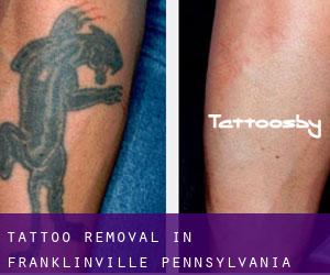 Tattoo Removal in Franklinville (Pennsylvania)