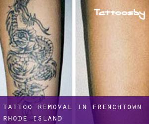 Tattoo Removal in Frenchtown (Rhode Island)