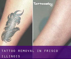 Tattoo Removal in Frisco (Illinois)