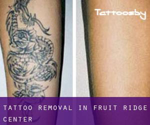 Tattoo Removal in Fruit Ridge Center