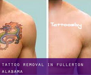 Tattoo Removal in Fullerton (Alabama)