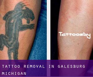 Tattoo Removal in Galesburg (Michigan)