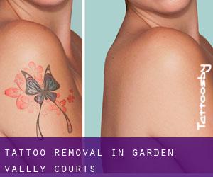 Tattoo Removal in Garden Valley Courts
