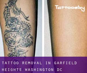 Tattoo Removal in Garfield Heights (Washington, D.C.)
