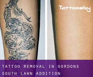 Tattoo Removal in Gordons South Lawn Addition